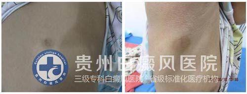 9岁女孩背部、腋下白斑在我院治愈