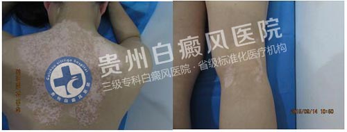 坚持不懈的治疗,白斑总有痊愈的一天