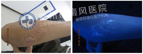 20年白斑终治愈,喜不自禁