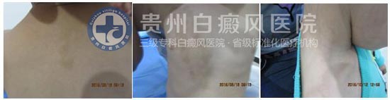 告别白斑,还孩子一个“无瑕”的童年