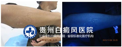 20年白斑终治愈,喜不自禁