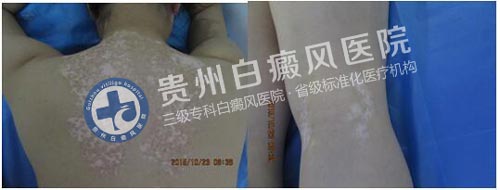 坚持不懈的治疗,白斑总有痊愈的一天