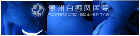 告别白斑,还孩子一个“无瑕”的童年