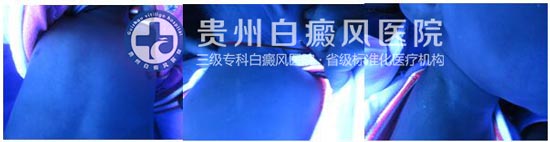 告别白斑,还孩子一个“无瑕”的童年