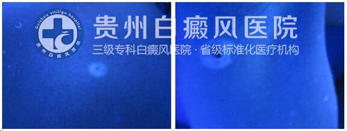 9岁女孩背部、腋下白斑在我院治愈