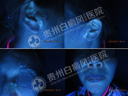 【第491面锦旗】面部多处白斑终治愈,患者感恩送锦旗