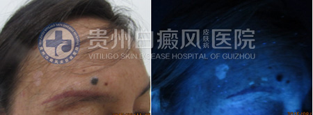 【第491面锦旗】面部多处白斑终治愈,患者感恩送锦旗